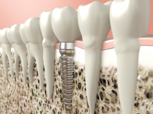 Dental implants provide support for your mouth that can't be found in other treatments for missing teeth.