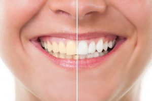 We have the secret to a brighter smile: Teeth whitening!