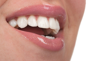 Professional dental bonding by your Naperville dentist are an important way to keep your teeth healthy.