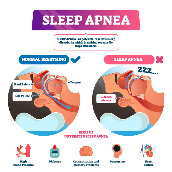 Seeing what the difference is from a normal airway vs. sleep apnea obstructed airway