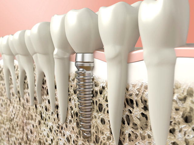 3d model of Dental Implants placed by Cosmetic Dentist Dr. Weyneth in Naperville
